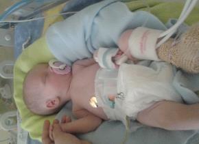 Nicolas Nicolas se narodil 30. 4. 2013. Hned v prvním týdnu života musel podstoupit operaci mozku vlivem rozsáhlého krvácení po instrumentálním porodu.