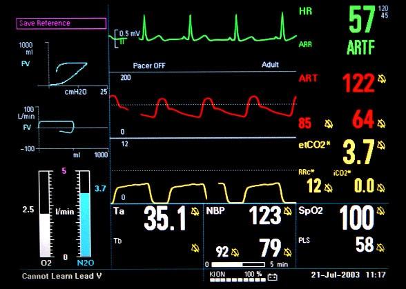 Monitorace EKG, pulzní oximetrie, kapnografie, invazivní TK, diuréza SvjO2
