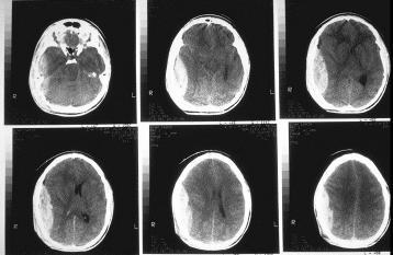 Klinické použití monitorace následků ischemického poškození mozkové tkáně (sekundárního