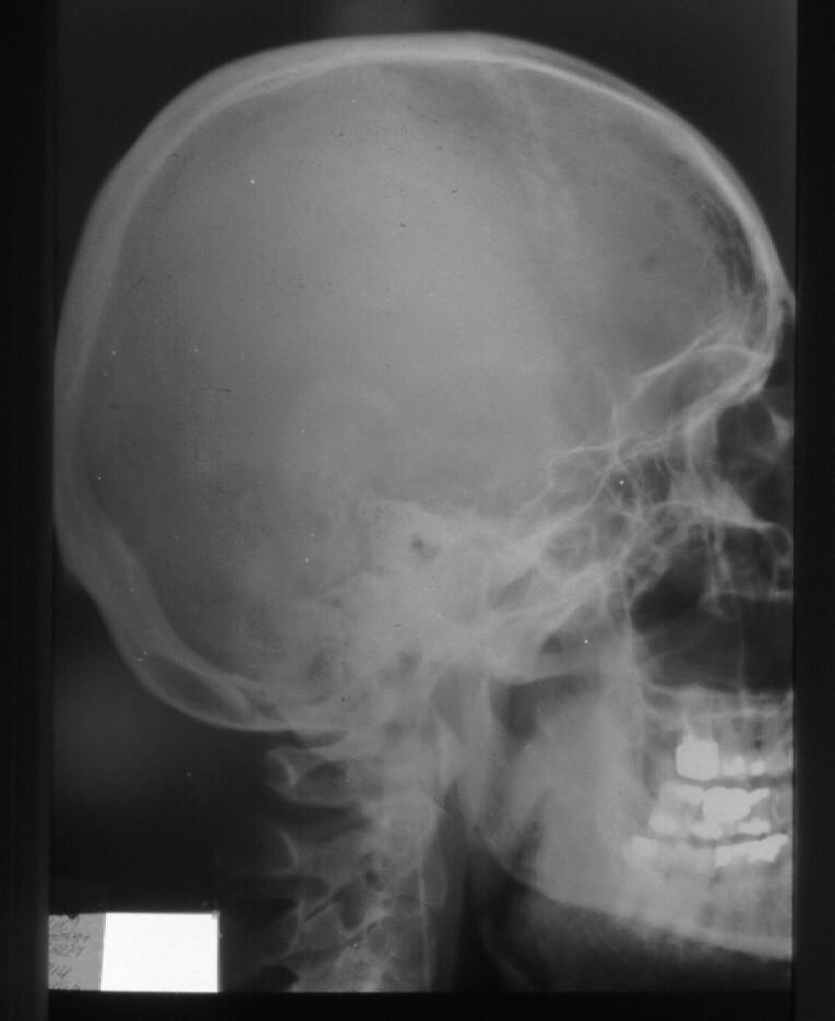 intraparenchymové