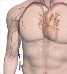 PICC (PERIPHERALLY