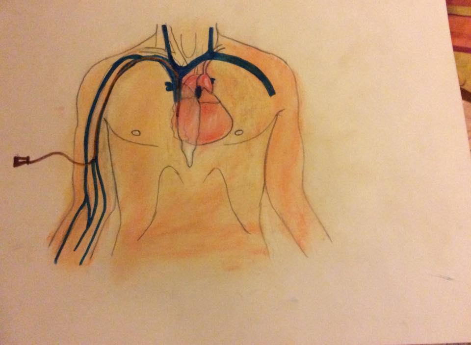 CATHETER) Zavedení