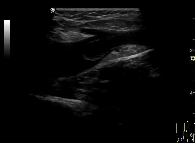 EHIT (ETIT) Endovenous Heat