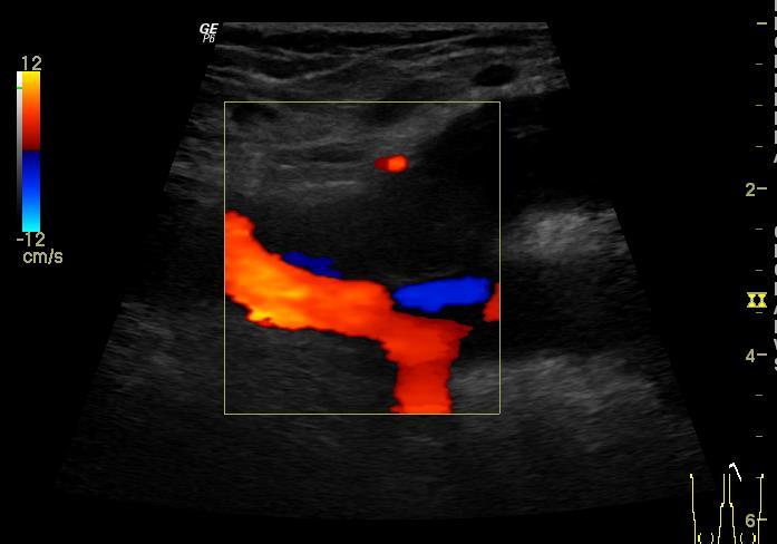 EHIT (ETIT) Endovenous Heat