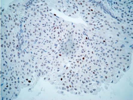 Imunochemické metody se užívají čím dál více i v oblasti cytologické diagnostiky. Rozšíření cytologického vyšetření moči o imunocytochemii by tak mohlo přispět ke zvýšení senzitivity tohoto vyšetření.