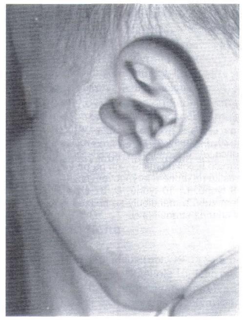 Vývoj vnějšího ucha meatus acusticus externus 1.