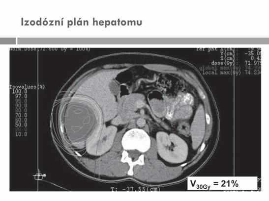 Může protonová léčba