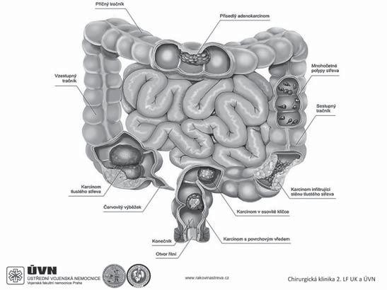 Současný náhled na rozsah resekce u karcinomu kolorekta XXIV.