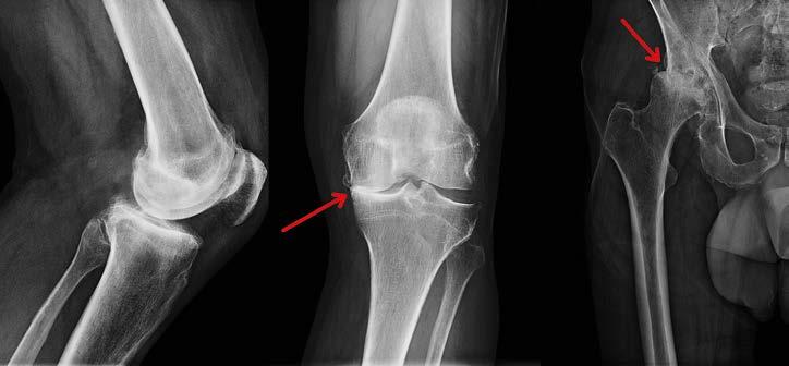 Obr. 1. Osteoartróza velkých kloubů, vlevo kolenní a vpravo kyčelní kloub Obr. 2.
