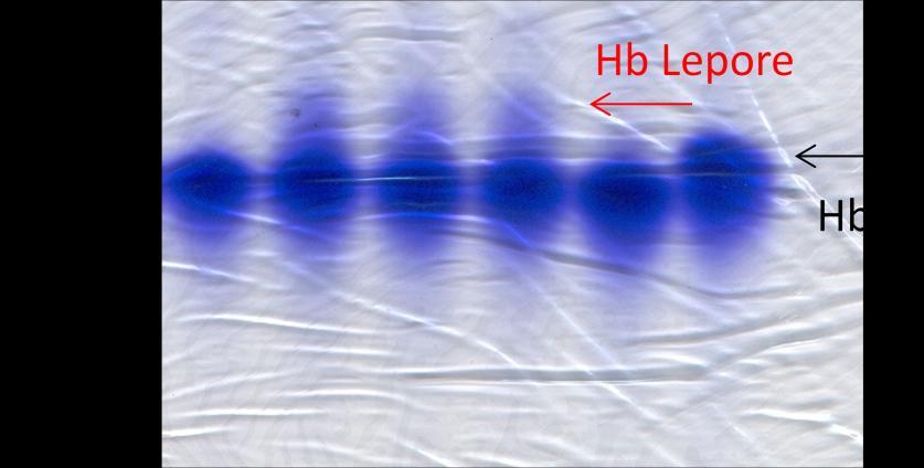A B Obr. 12: Proteinová a DNA diagnostika Hb Lepore. (A) Proteinová elektroforéza, polyakrylamidový gel barvený Coomasie blue.