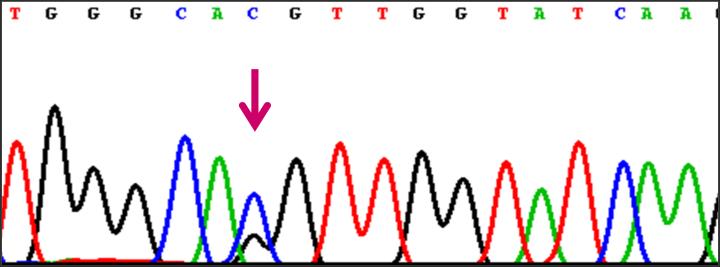 Hemoglobin Knossos (β27 Ala Ser) (HbVar ID 281; HBB: c.82g>t) jsme v našem souboru detekovali u tří jedinců ze tří nepříbuzných českých rodin.