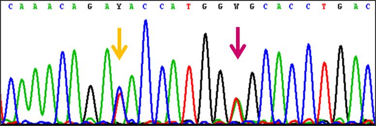 A B Obr. 19: DNA a proteinová diagnostika Hb Doha. (A) Výsledný chromatogram části HBB genu pacienta s Hb Doha, jedná se o hererozygotní nosičství.