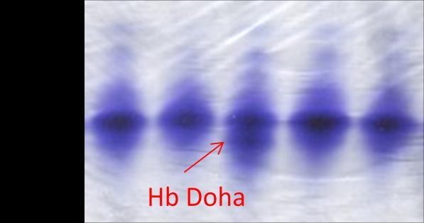 -4c>t) (žlutá šipka). (B) Proteinová elektroforéza, polyakrylamidový gel barvený Coomasie blue. Červená šipka označuje frakci Hb Doha, který putuje rychleji než HbA.