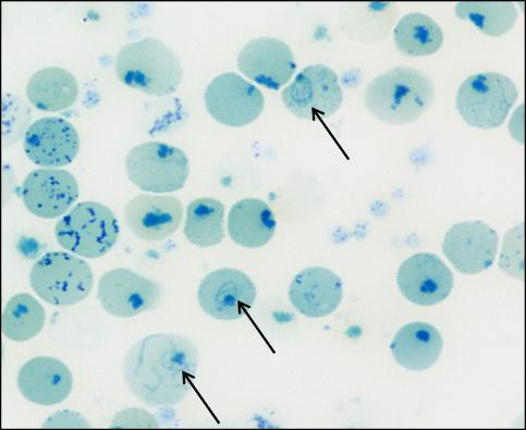 (B) panoptické barvení dle Pappenheima s nálezem akantocytů, echinocytů, stomatocytů, terčovitých erytrocytů, bazofilního