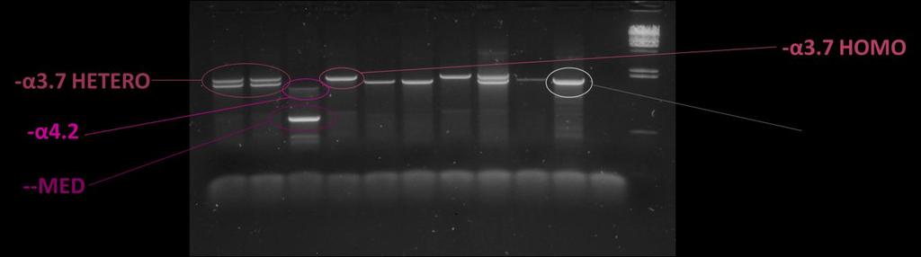 kontrolní amplifikace α2 Obr. 23: Ukázka agarózového gelu (1%) s výsledky multiplexní alelově-specifické PCR (ASO- PCR). Jsou vyznačeny vzorky nemocných s delecí -α 3.