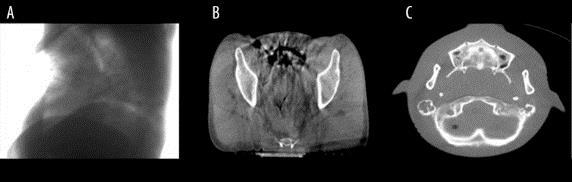 Applications of linac-mounted kilovoltage Cone-beam Computed Tomography in modern radiation therapy: A review.