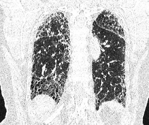 Radiologist identified advanced pulmonary fibrosis in the dorsal part of the lungs has been recognized the presence of honeycombing.