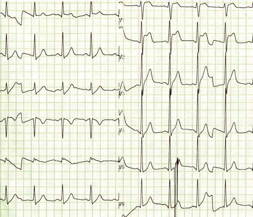 O. Bolek, D. Marek, M. Táborský 675 Obr. 7 Kasuistika: EKG 20 minut po kardiopulmonální resuscitaci na kardiologickém oddělení kardiologickém oddělení byly opět změny typické pro BrS (obr. 7).