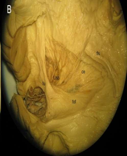 Lateral lentikulostriatic perforating arteries running below fasciculus uncinatus fu) and through resected