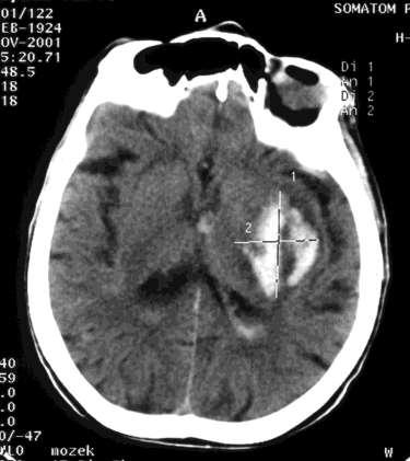 Intracerebrální hematom (ICH) - typické