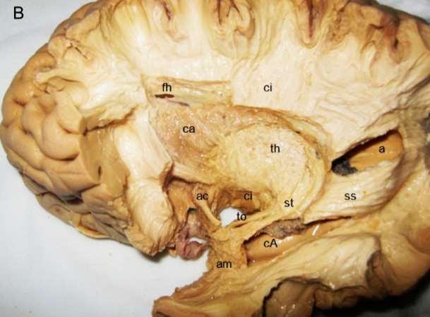 B. Dissection explaining location of basal ganglia to the ventricular system, resection of fasciculus uncinatus, uncovering of thalamus with the entry of optic tract, lateraly from the occipital horn