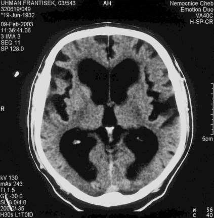 Diagnosa NPH 1.