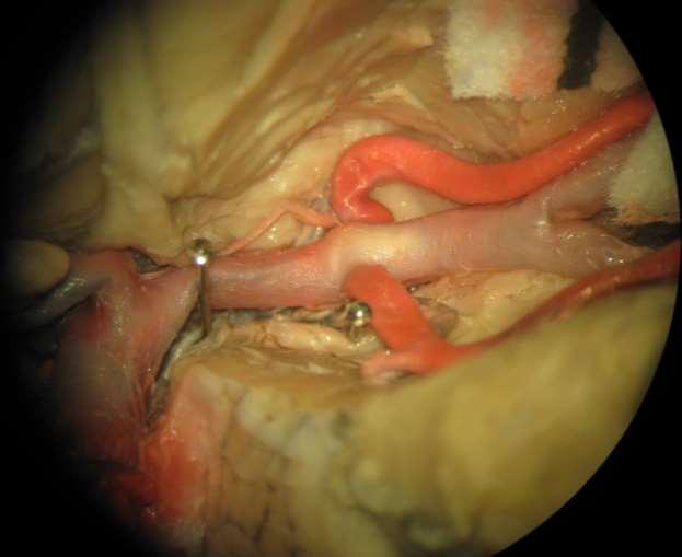 Arteria cerebri media: early frontal& temporal branch,
