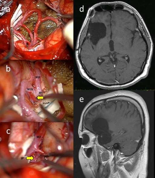 Insula