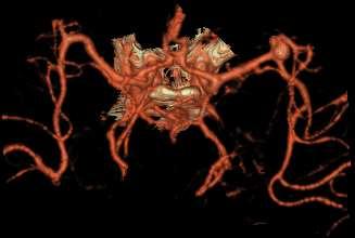 CT angiografie