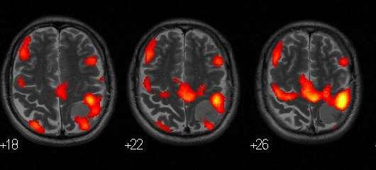 fmri -
