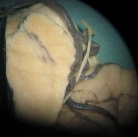 Lemniscus medialis zadní provazce (propriocepce, dotyk,