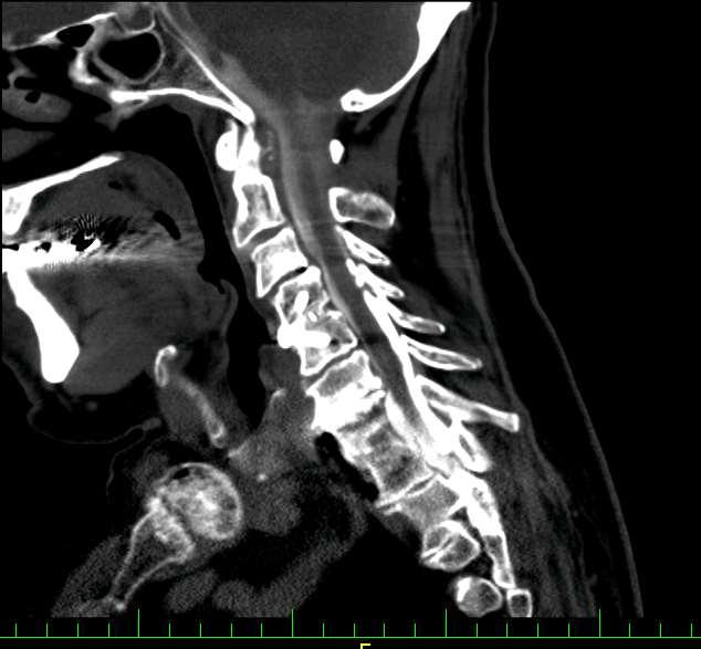 PMG-CT