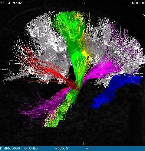 MRI DTI