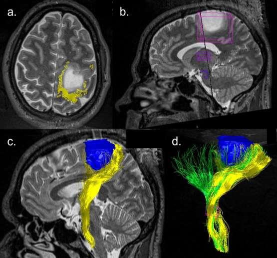 Tumor -