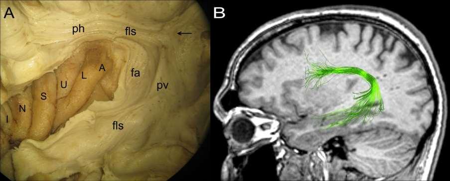 B. DTI reconstruction of fasciculus longitudinalis superior Fasciculus longitudinalis superior - arcuatus A.