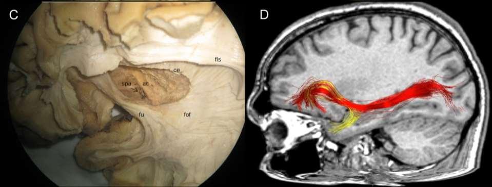 C. View from above on commissura anterior and substancia perforata anterior (spa), remarkable is cortical projection of