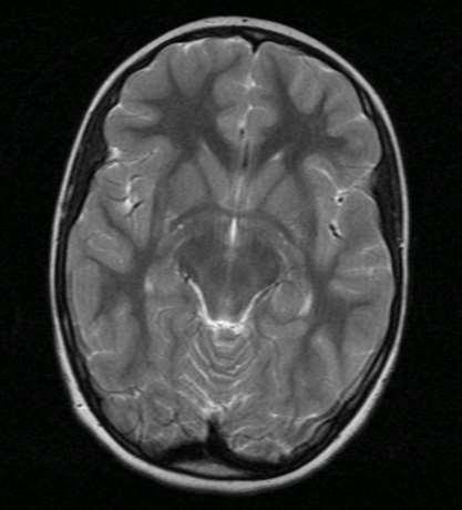 Commissura anterior: Anterior olfactory limb (větévka) (30% absent)