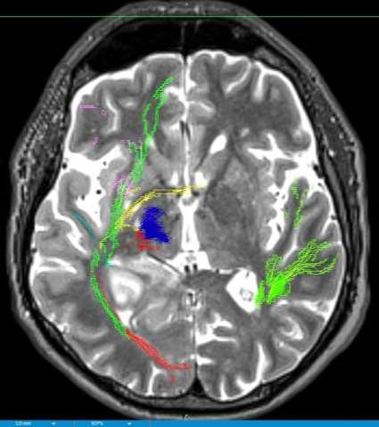 Temporal stem + stratum saggitale (+