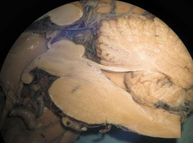 Mesencefalon - Pons - Medulla oblongata S VCI VBR CRBL III M VMS CM IV P VMI O
