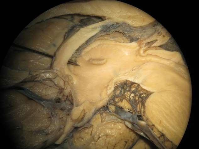 Hypothalamus: Lamina terminalis, infundibulum, corpora