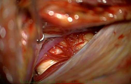 Metathalamus: corpus geniculatum laterale,