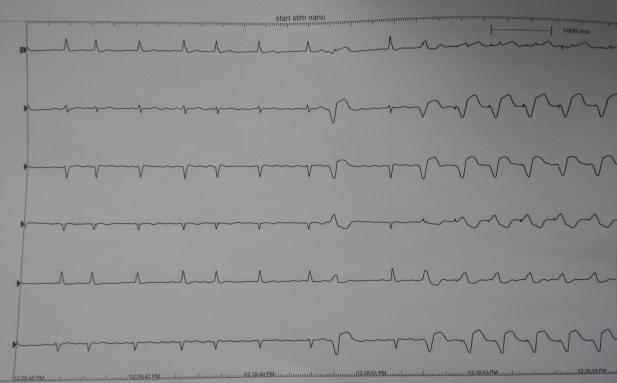 První celosvětová implantace 2.12.2012 v NNH Úspěšnost implantace: 32/33 (97%) Čas výkonu : zavaděč punkce / vytažení: 28 min (11 74 min) katetr zavedení/vyjmutí: Počet repozic: průměr 0.