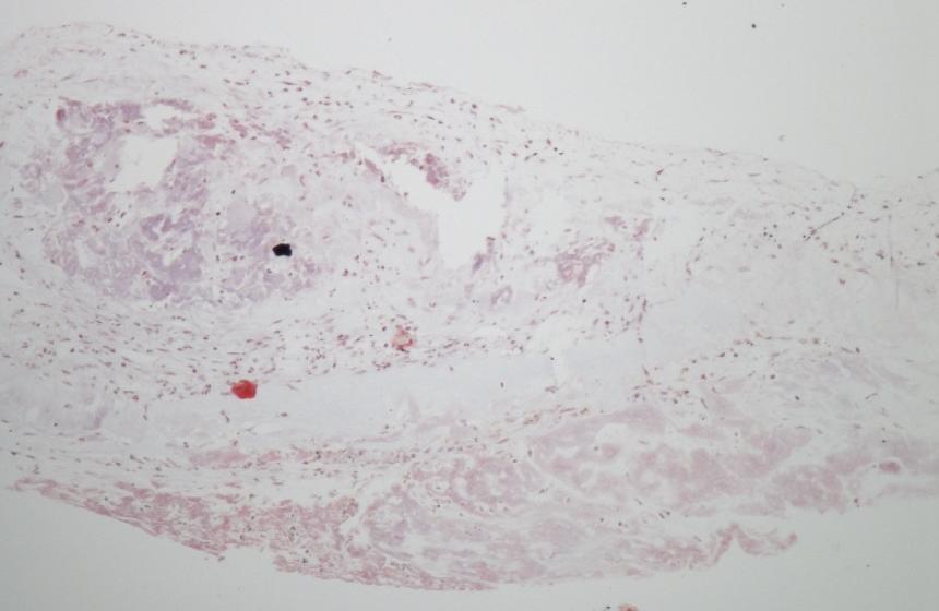 Extrakce: chronicky implantovaná Micra HISTOLOGIE (1 rok + 30 dní) A B C Popis histologie: A.