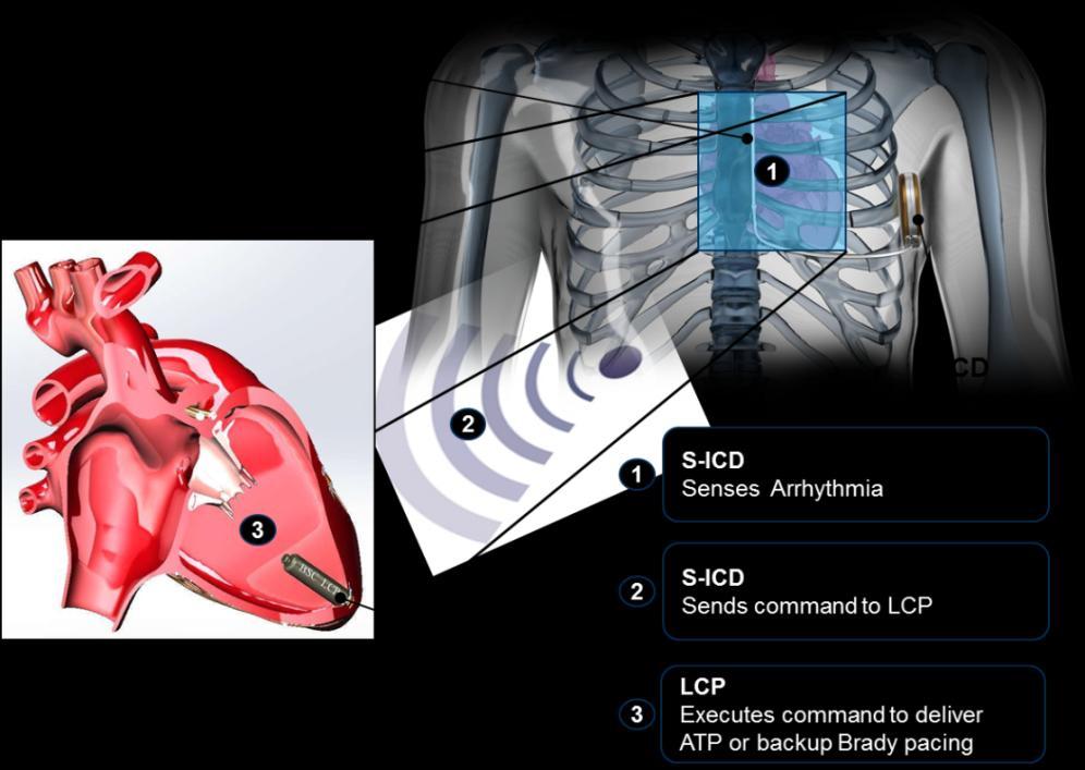 Leadless Pacing in the Future: Compliment to S-ICD Leadless pacing