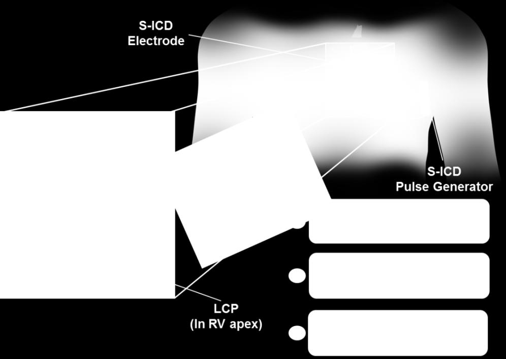 commanded ATP should S-ICD patients exhibit pace terminal