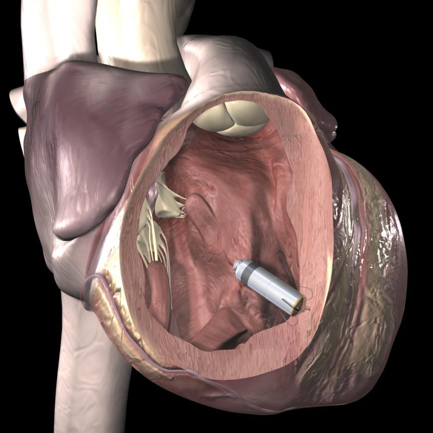 Micra VVIR Pacemaker Intended for patients that have a Class I or II indication