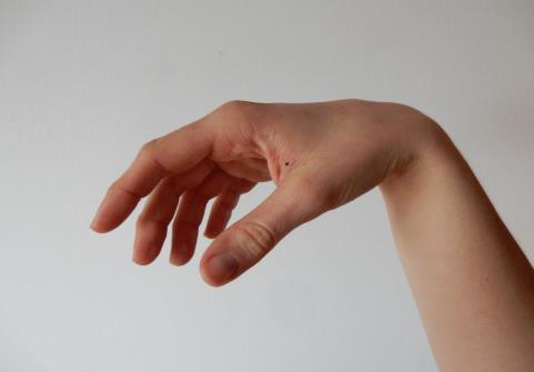 Tímto polohováním rukou se dosáhne tenodézy (mírně stažené flexory prstů, při palmární flexi v zápěstí se prsty natáhnou a při aktivní dorzální flexi ruky se prsty pasivně sevřou v dlaň). Obr. č. 3.