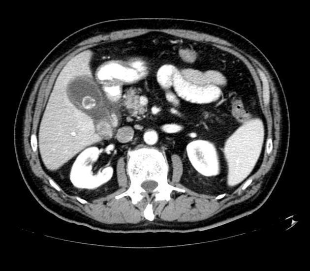 Obrázek 2 CT axiální řez- akutní cholecystitida Zdroj: https://radiopaedia.org/articles/acute-cholecystitis 2.1.