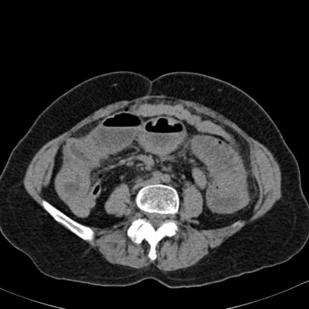 Obrázek 4 CT axiální řez - mechanický ileus Obrázek5 CT axiální řez - hernie zdroj obr. č. 4: https://radiopaedia.