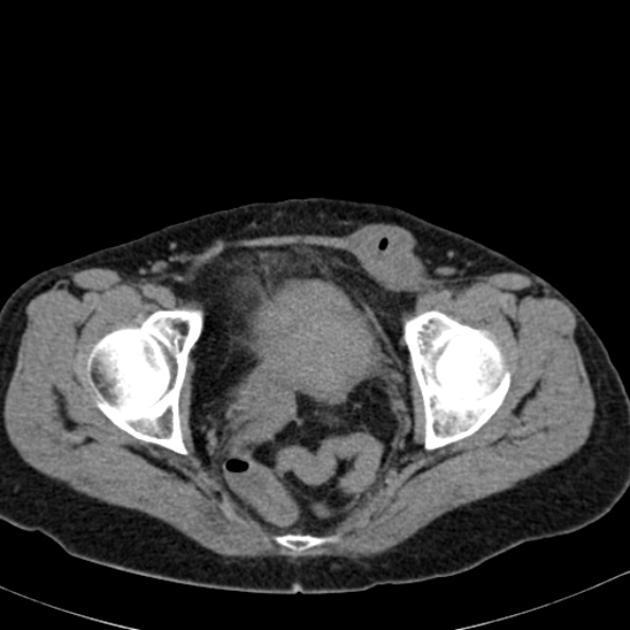 org/articles/small-bowel-obstruction Neurogenní ileus se dá dělit na paralytický, který je charakterizován zástavou peristaltiky.